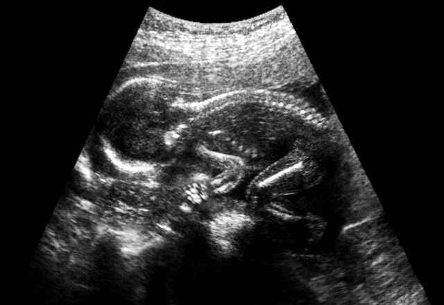 Baby spine ultrasound
