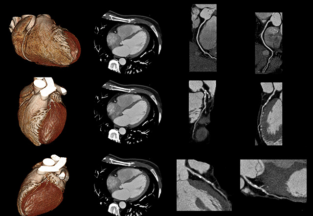 cardiac ct johns hopkins - image of ct scan of the heart