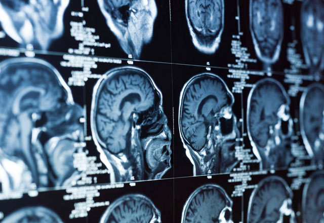 Set of brain scans