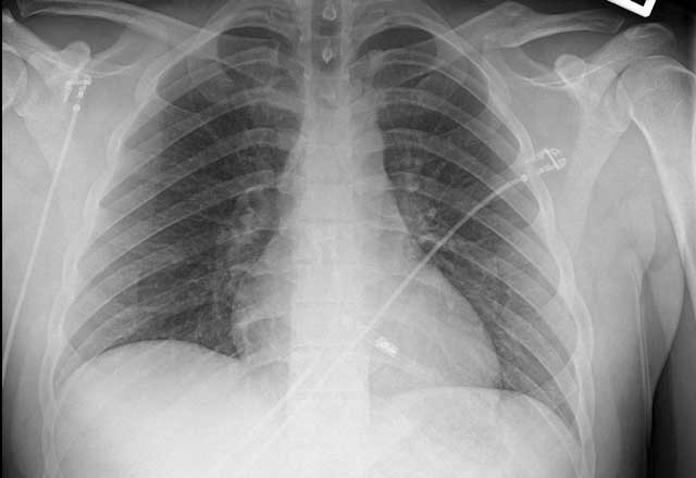 Chest x-ray with a leadless pacemaker