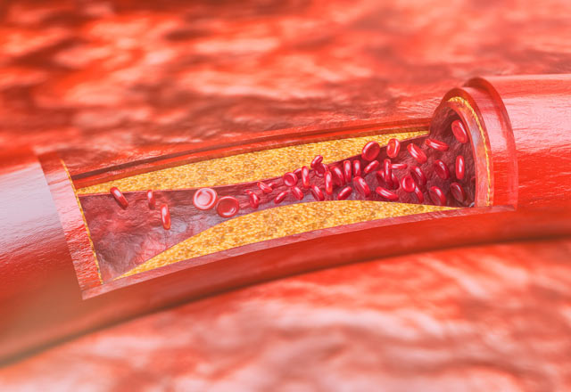 Artery with plaque buildup