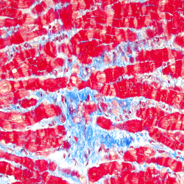 CVR150913 WEB IMAGES_heart failure