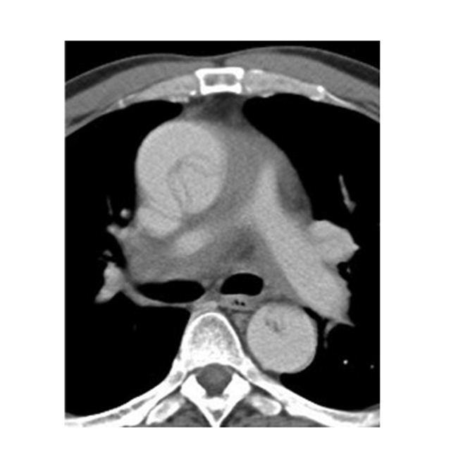Aortic Dissection Type A_640px