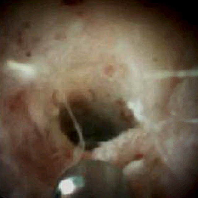 Inflammatory changes of bile duct with underlying malignancy