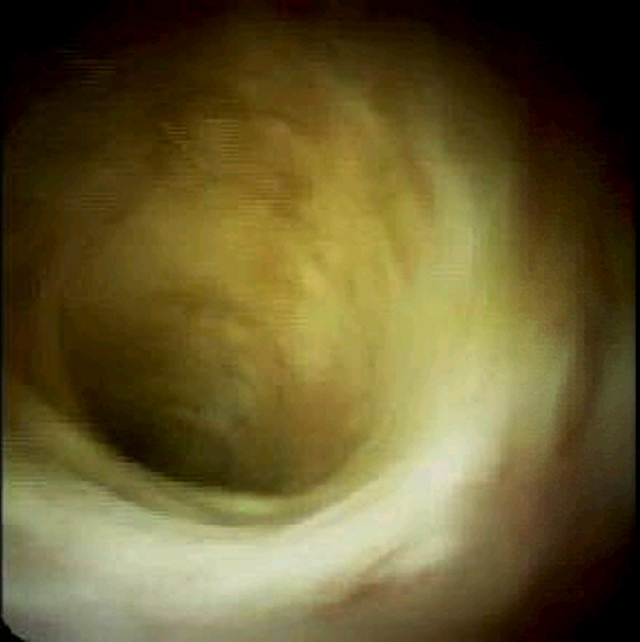Normal bile duct