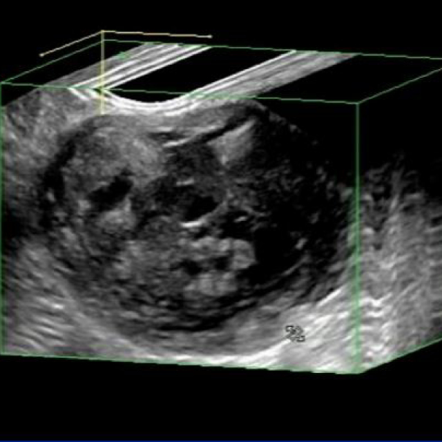 ITR1608047 Web Images_pancreatic cyst