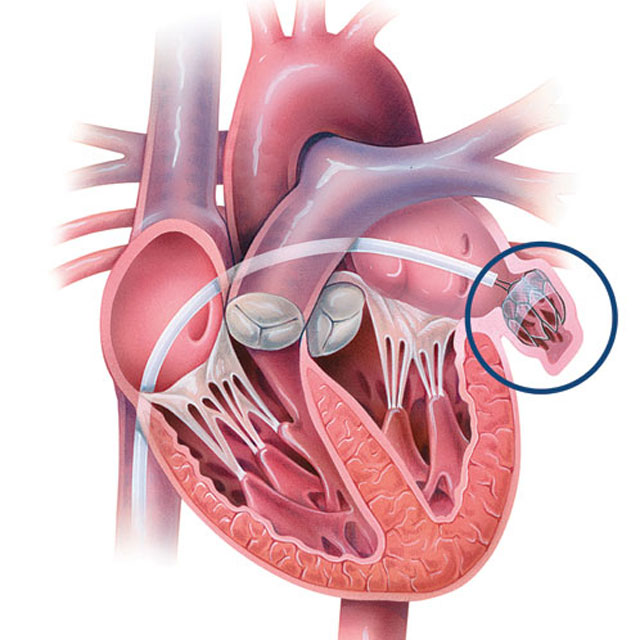 LAA heart