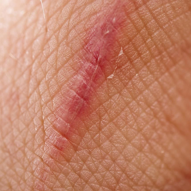 Close-up image of a scar on the skin