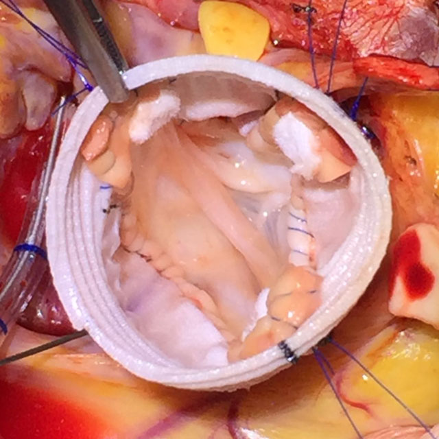 Photo shows a valve-sparing aortic root replacement in a 6-year-old child with Loeys-Dietz syndrome with aortic root aneurysm and bicuspid valve. The aortic valve is re-implanted and preserved within a prosthesis, retaining its functionality while the tissue at risk of rupture or dissection is replaced with the prosthesis.
