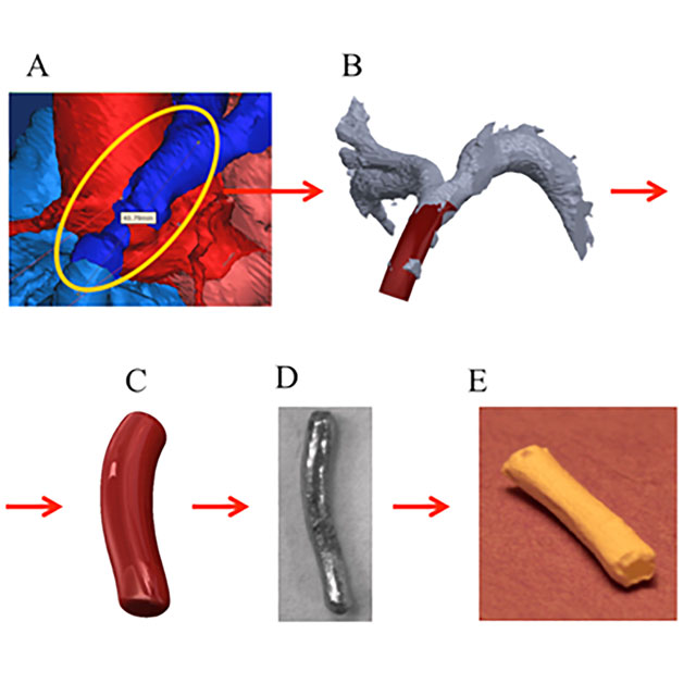 Flow chart depicting the proposed process for manufacturing patient-specific tissue-engineered vascular grafts. 