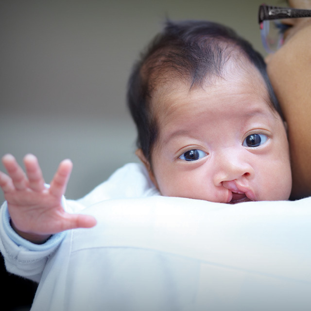 A photo shows a baby with a cleft lip and palate. 
