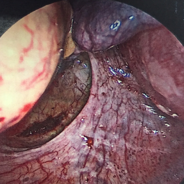 GYN1708056_KN_Johns Hopkins GYN_Winter 2018_WEB-Endo 1