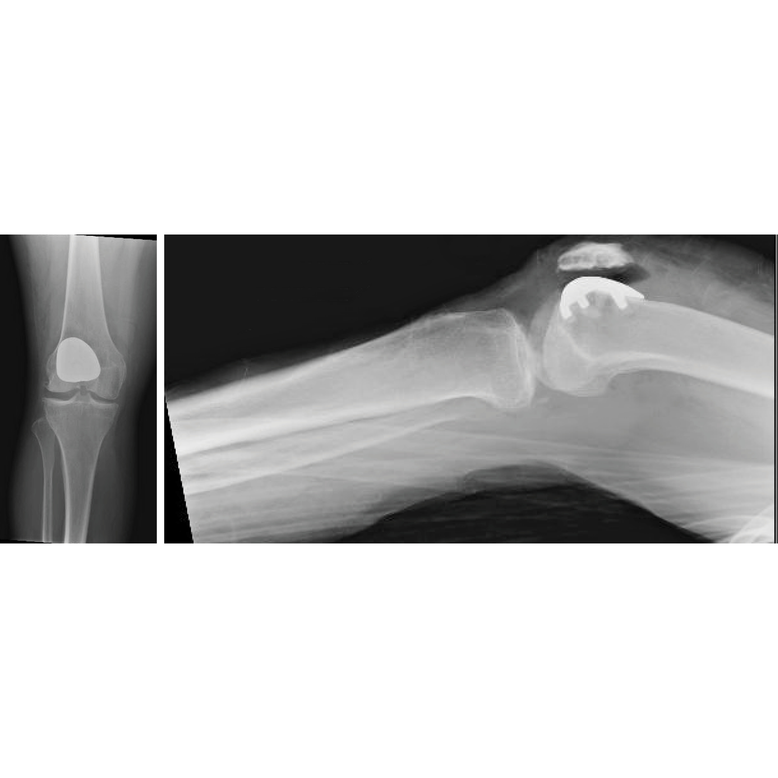 X-rays show a 55-year-old patient who underwent patellofemoral arthroplasty for isolated patellofemoral arthritis.