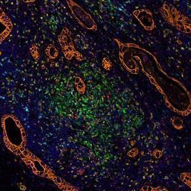An image shows pancreatic cancer after immunotherapy.