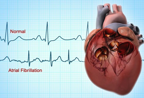 biomarker-afib-treatment
