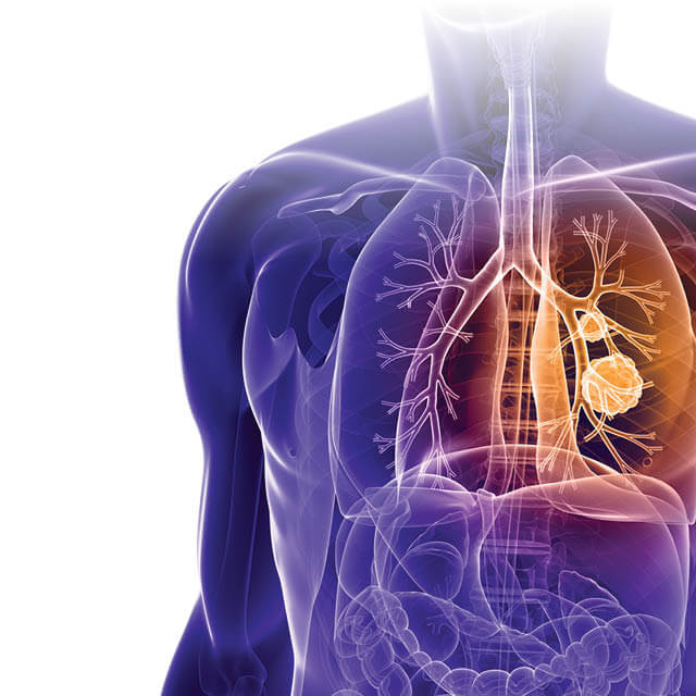 A graphic represents cancer in a lung. 