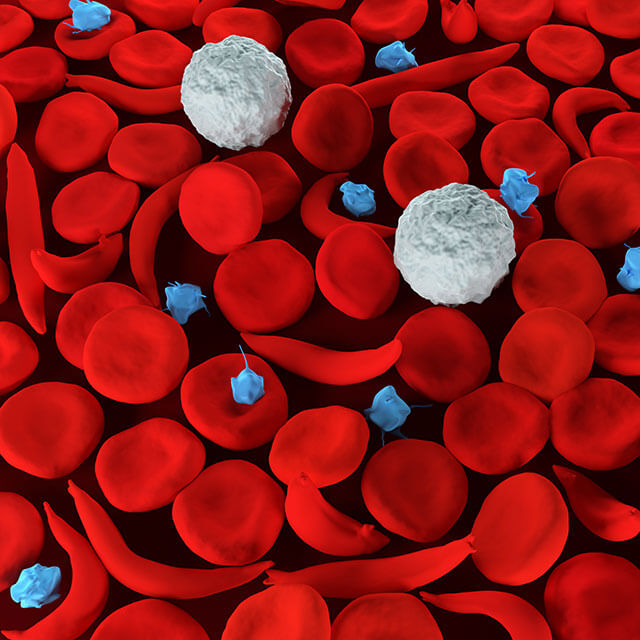 sickle-cell
