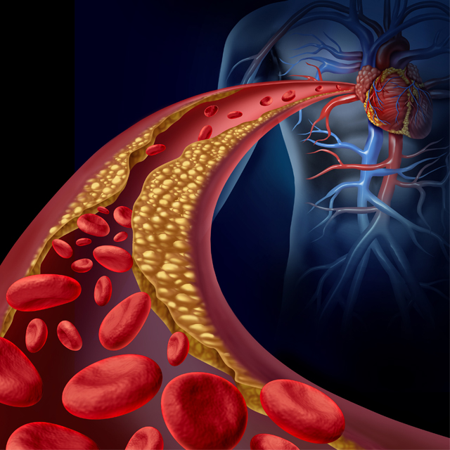 An illustration shows a clogged artery.