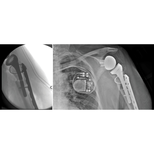 The X-ray on the left shows a patient’s failed shoulder implant. The one on the right shows the revision with the new prosthesis and a plate.