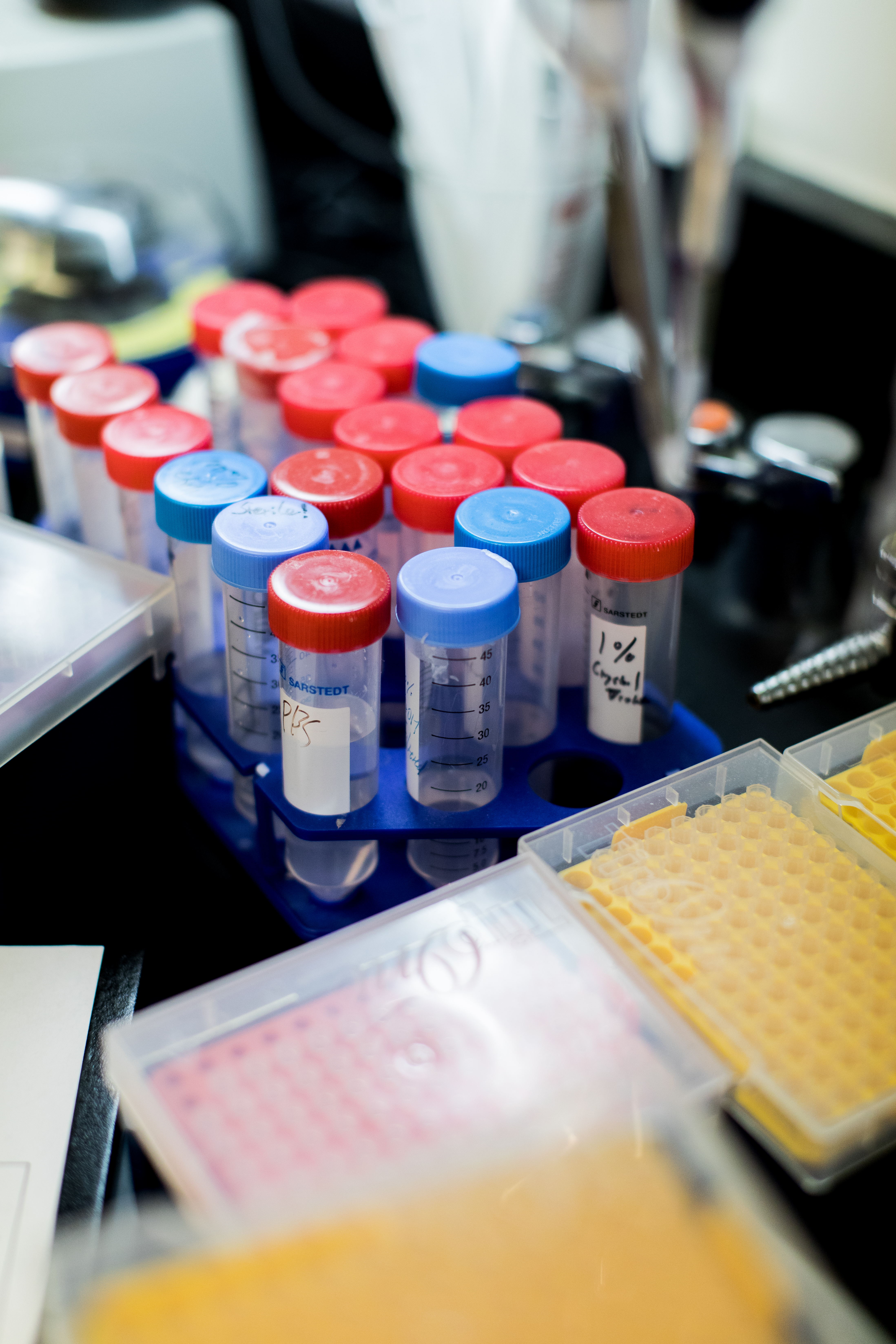 Prostate Cancer Liquid Biopsy