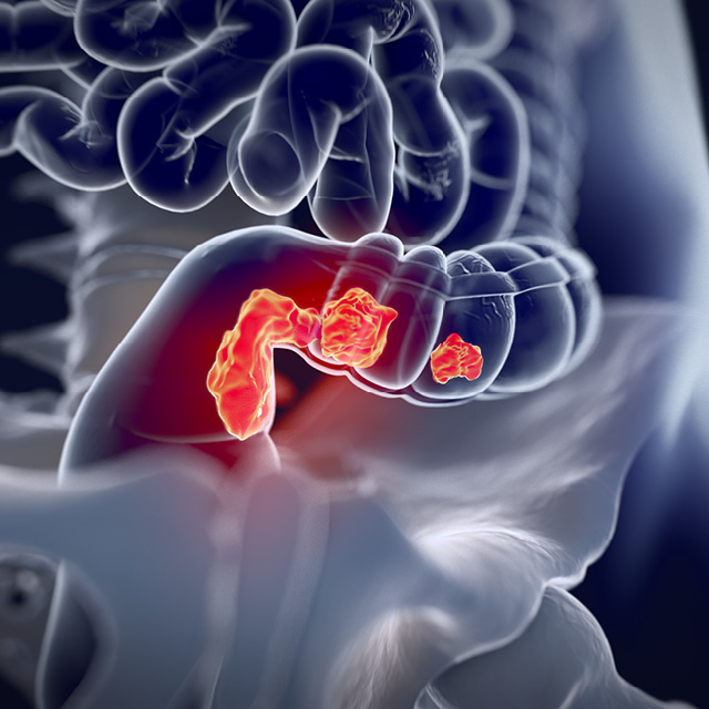 A graphic shows a colorectal lesion.