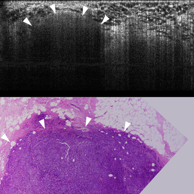 One image shows optical coherence tomography and the other shows a hematoxylin-eosin–stain. 