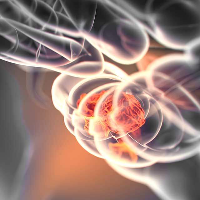 A graphic shows colorectal cancer. 