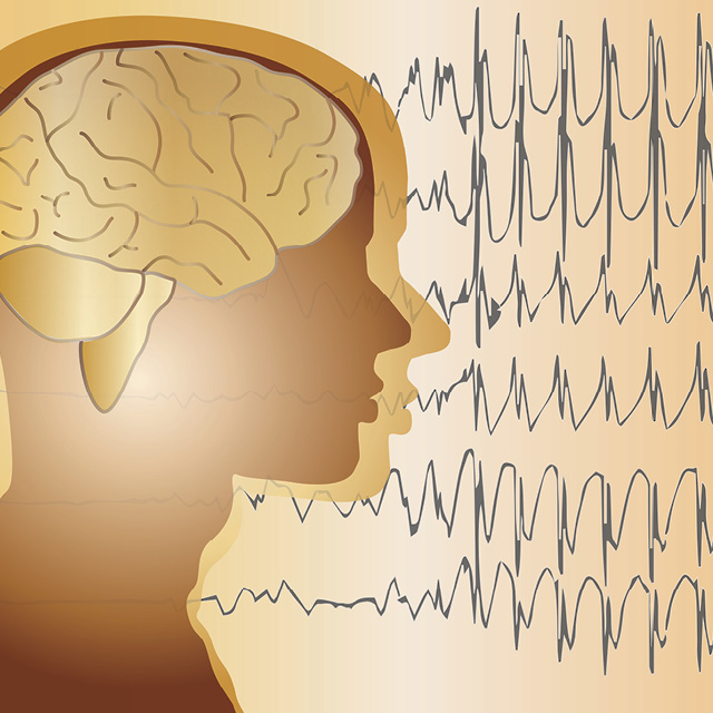 A graphic represents epilepsy. 