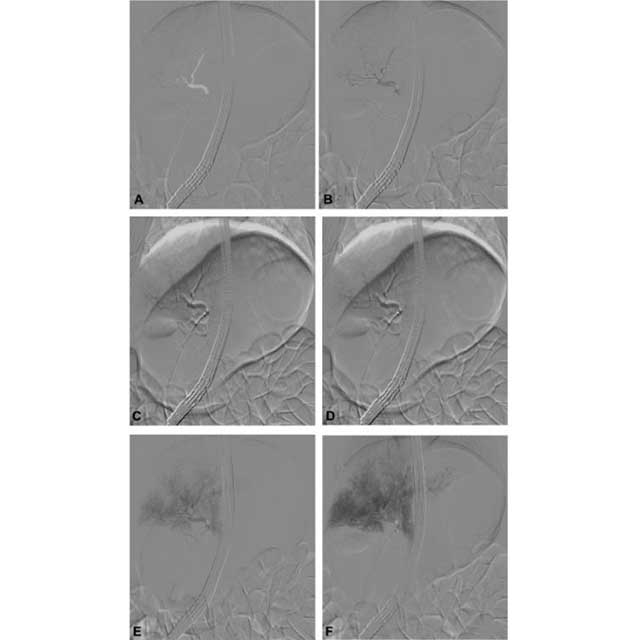 A graphic shows fluoroscopic snapshots of a contrast injection into a bile duct using ERCP. 