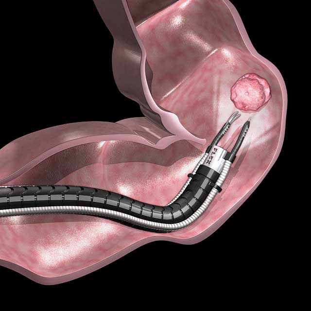 A graphic represents a robotic endoscopic resection.