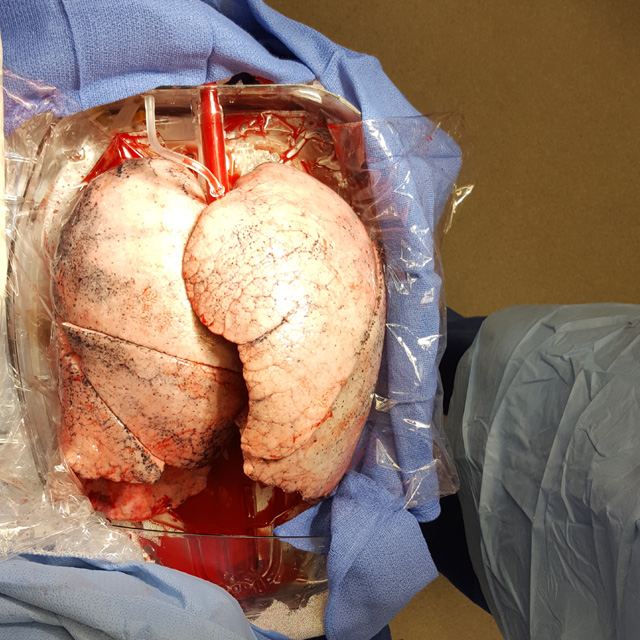 A photo shows a pair of lungs on an ex vivo machine. 