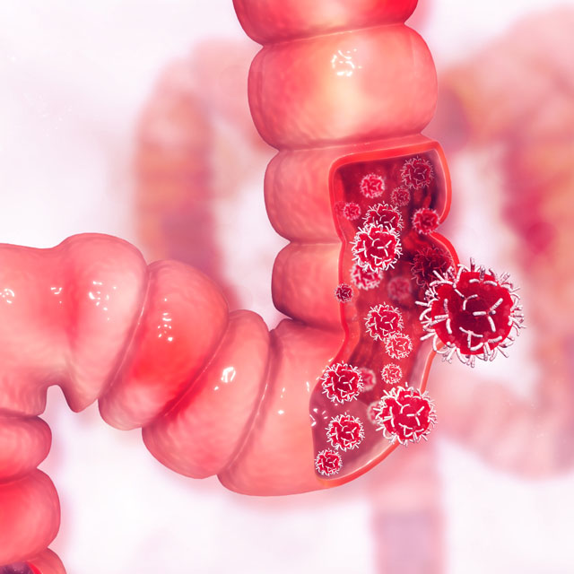 coloncancer