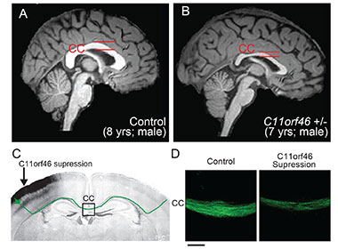 Images show how C11orf46 plays critical roles for transcallosal neural connectivity.