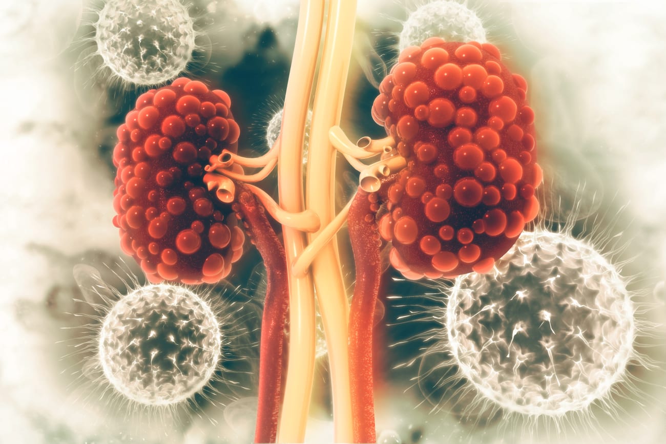 An image shows a 3D concept rendering of kidney disease.