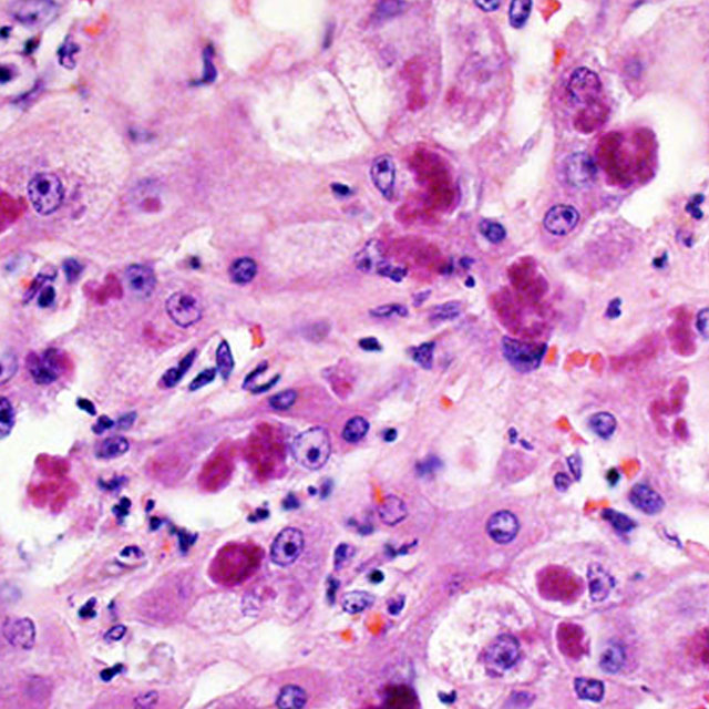 A histopathology slide shows liver cell damage from alcoholic hepatitis.