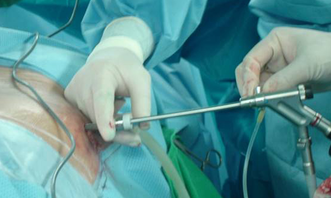 A photo shows an endoscopic discectomy procedure. 
