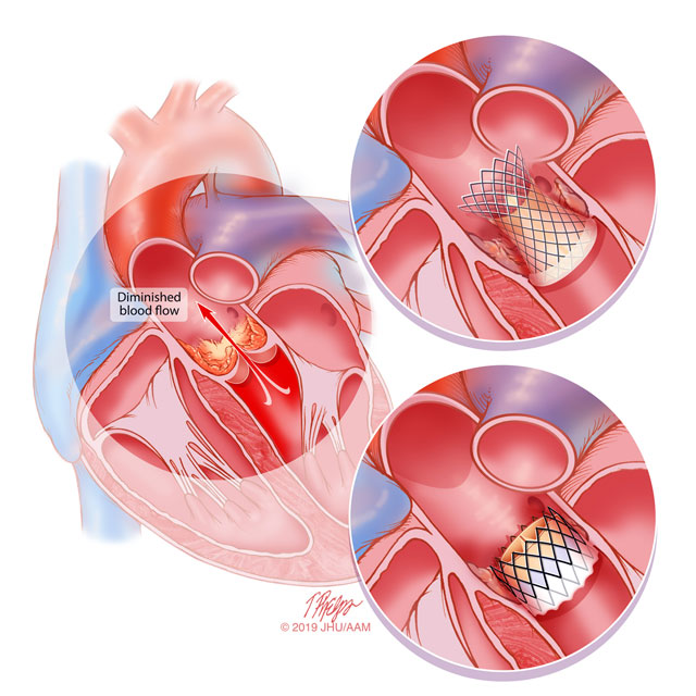 Illustration shows transcatheter aortic valve replacement (TAVR), a minimally invasive procedure to replace a narrowed aortic valve that fails to open properly. Physicians insert a catheter in the patient’s leg or chest and guide it to the heart. A replacement valve is inserted through the catheter and guided to the heart. A balloon is expanded to press the valve into place. Some TAVR valves are self-expanding.