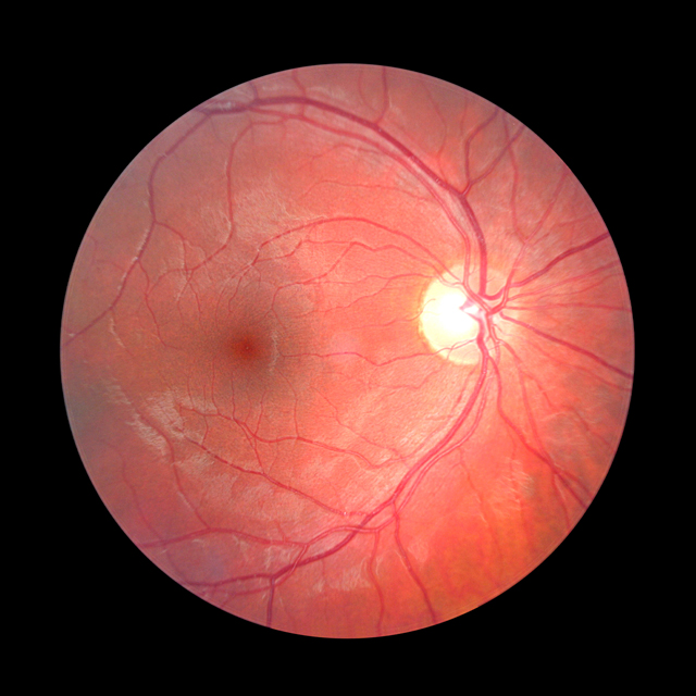 A photo shows the optic nerve.