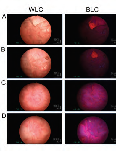 Slides showing the sensitivity of blue light cystoscopy, and compared the results with the final pathology diagnoses