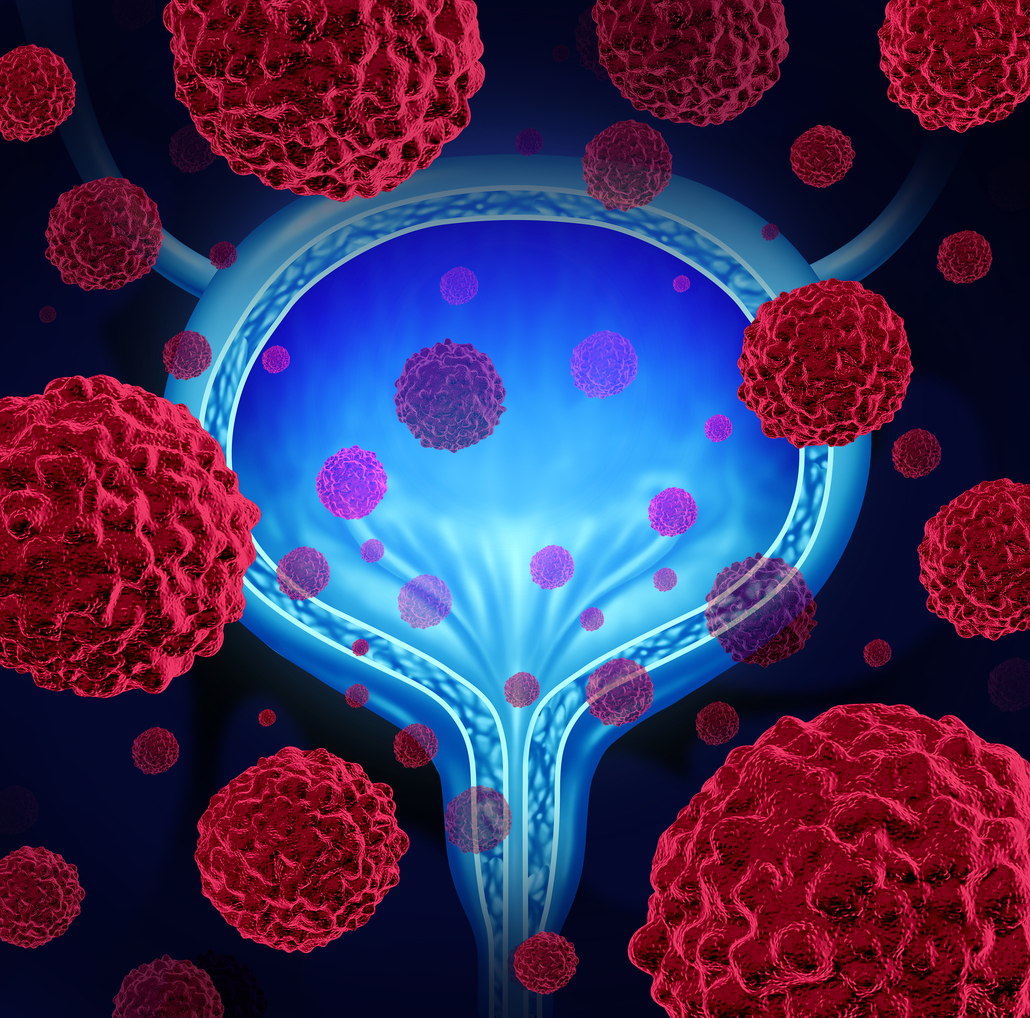 prostate cancer