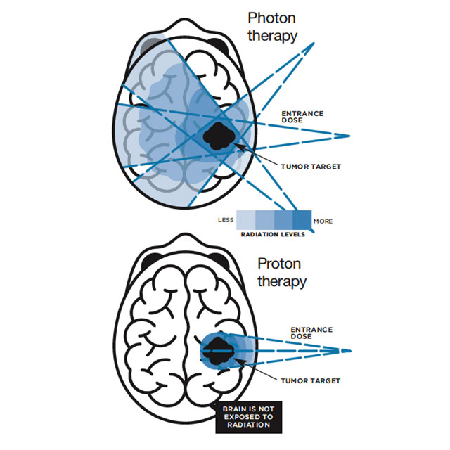 Illustration of photon vs proton beam on the brain