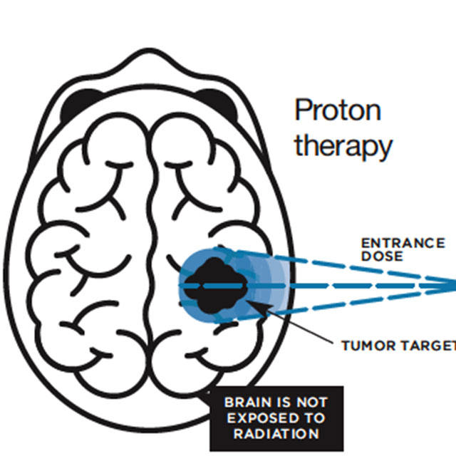Illustration of a proton beam on the brain.