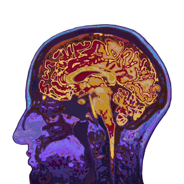 An MRI shows the brain.