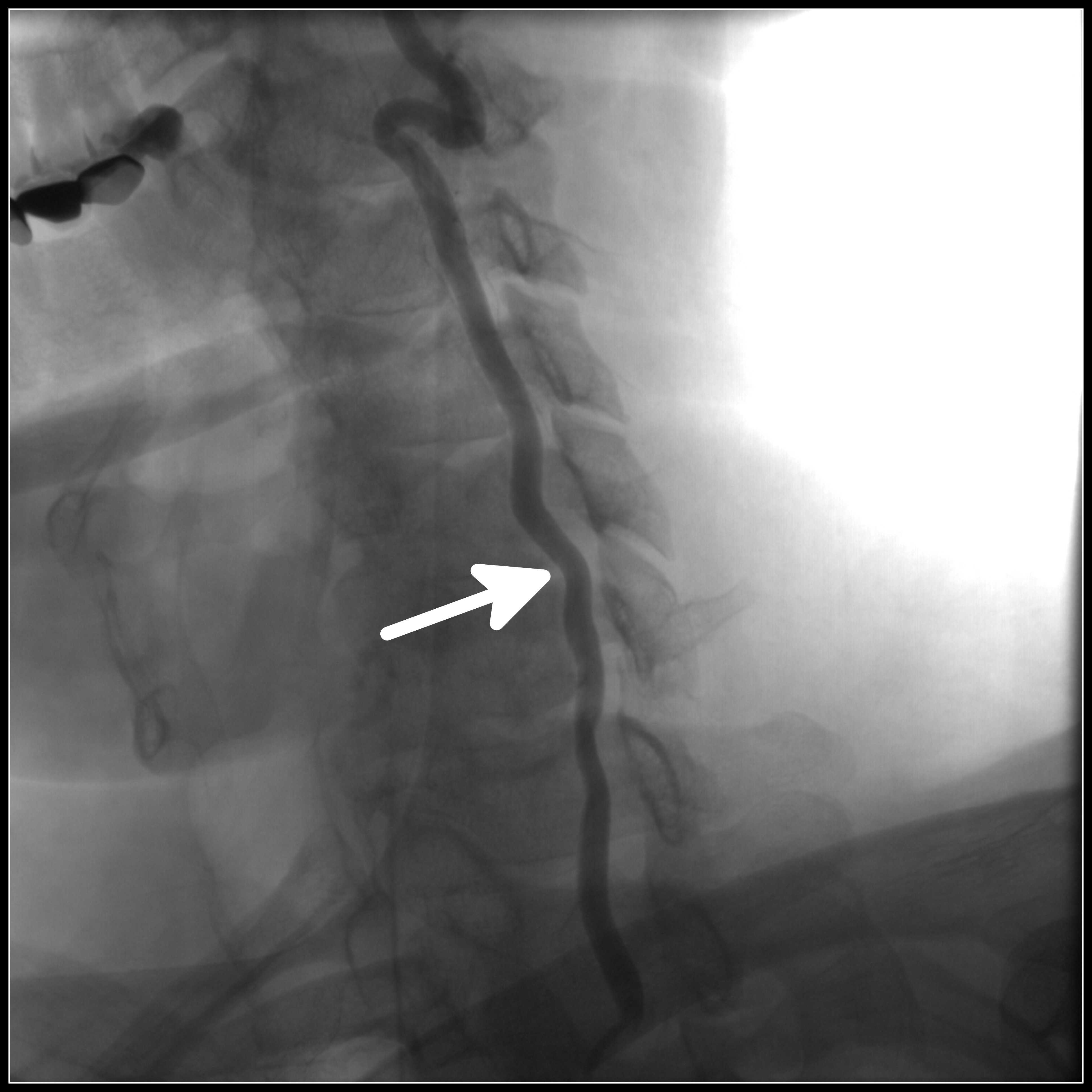 An x-ray of the neck and upper back with an arrow pointing to the vertebral artery, one of the neck’s major arteries.