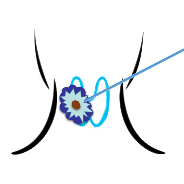 An illustration shows a pattern of damage from radiofrequency ablation.