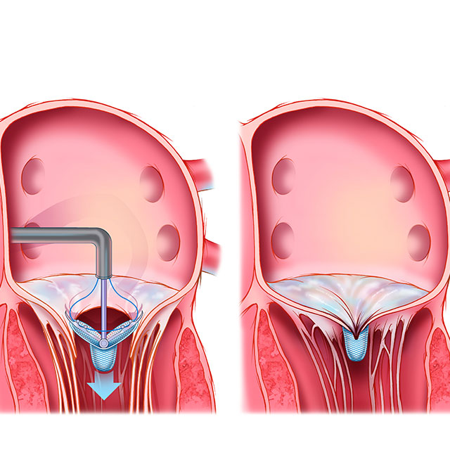 Illustration shows MitraClip deployed on the two leaflets of the mitral valve to reduce leaking of the valve. 