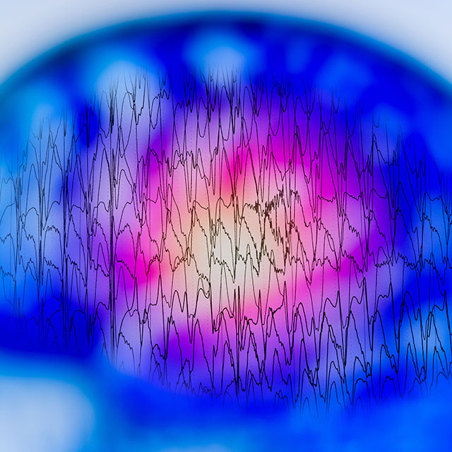 Abnormal brain activity is shown with multiple series of EEG readings represented by black lines, which are pictured with an out-of-focus brain structure in the background.
