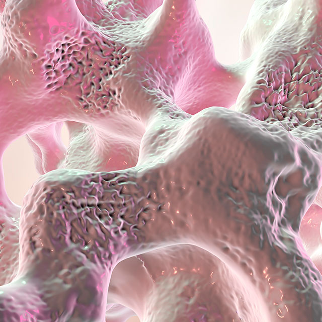 Spongy bone tissue affected by osteoporosis