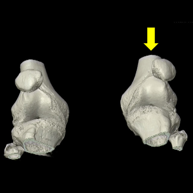 A static image captured from a dynamic 4DCT scan demonstrates unilateral patella maltracking in a 19-year old patient who has a history of recurrent patella dislocations.