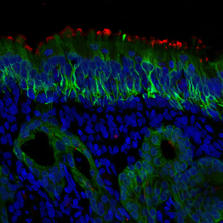 Microscope image of cells in the nose. Red stain is ACE2. The green probe is staining CK18, which is found in supporting cells and mucus glands.